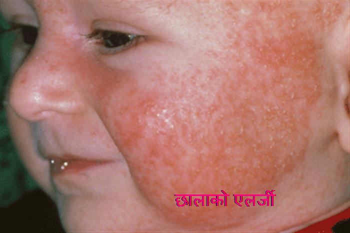 skin rash 2