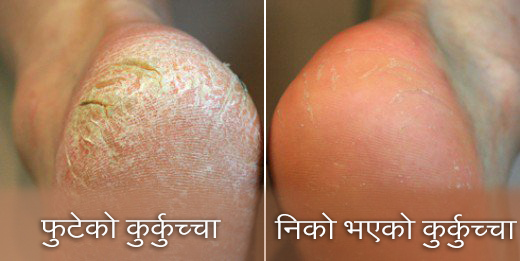 Callused Feet- Before and After