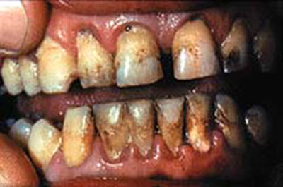 teeth cancer