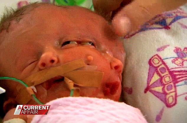 baby born with two faces