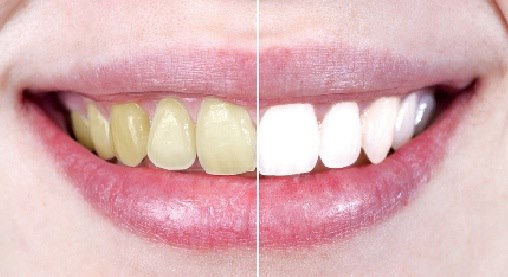white-teeth-from-yellow