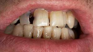 Teeth meaning 3