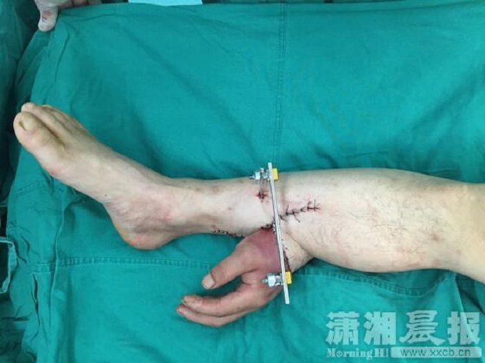 Surgeons successfully reattach a hand of a patient after grafting it into the patient’s leg and keeping it alive for a month