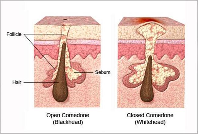 Skin Pores Blockage