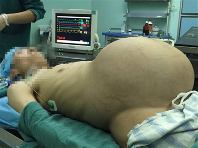 चीन खबर: गर्भवती जस्तै देखिने विशाल ट्यूमर सर्जरीको प्रतिक्षा गर्दै बिरामी