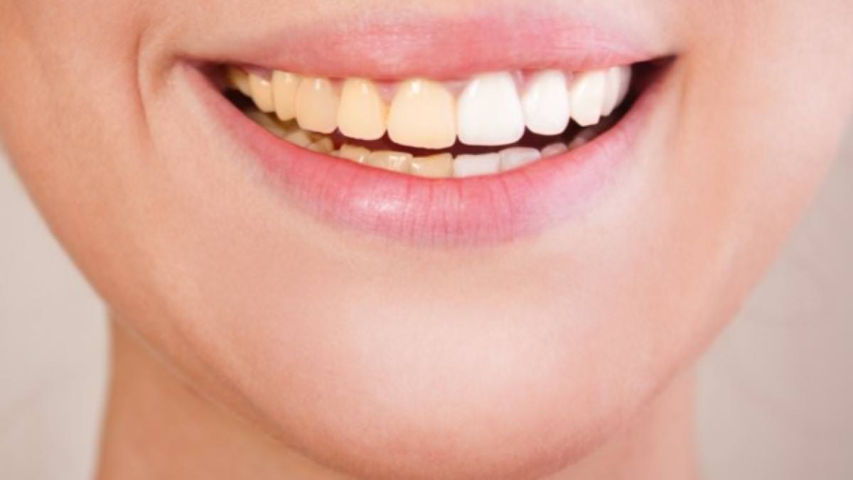 सेतो दाँतभन्दा पहेँलो दाँत बलियो र स्वस्थ हुने खोजको नतिजा…