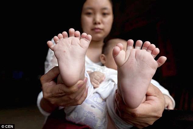 चीनमा १५ वटा हातको औँला र १६ वटा खुट्टाको औँला भएको बच्चा जन्मिएपछि…