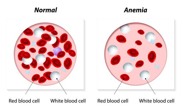 Three die of sickle-cell anaemia
